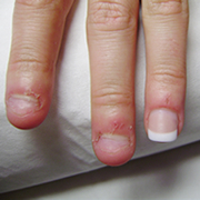 réparation d'ongle abimés ou rongés